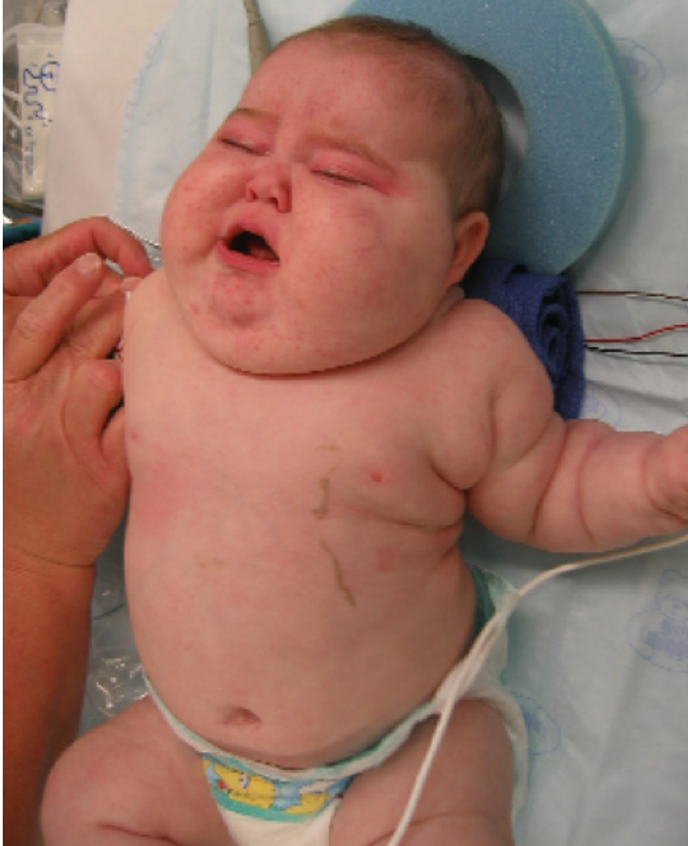 Cushing’s Syndrome