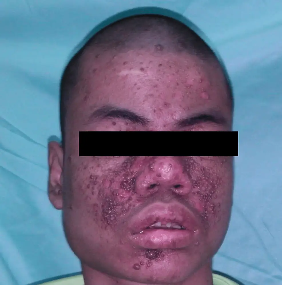 Tuberous Sclerosis