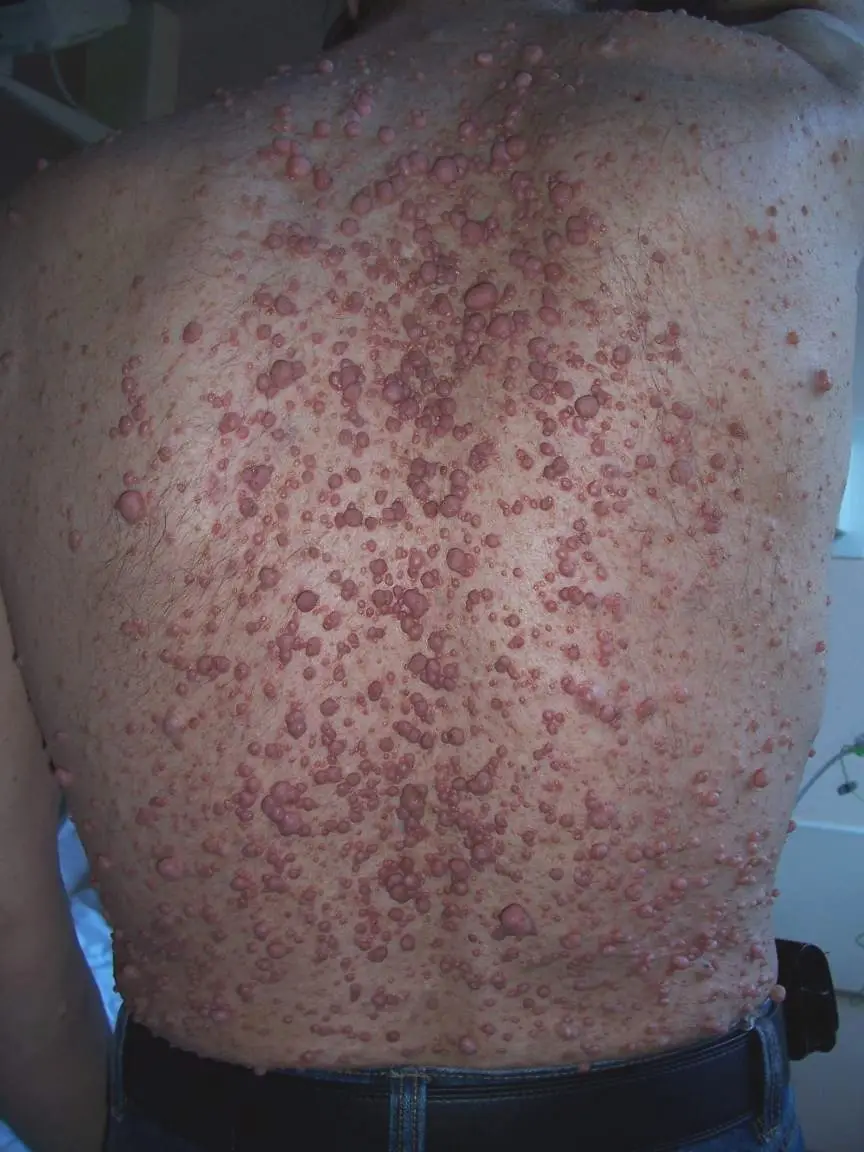 Signs in Dermatology
