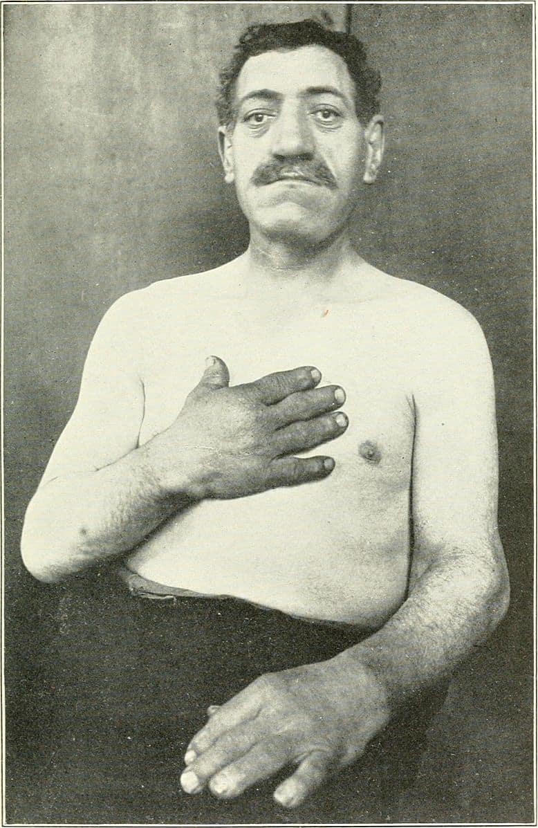 Acromegaly